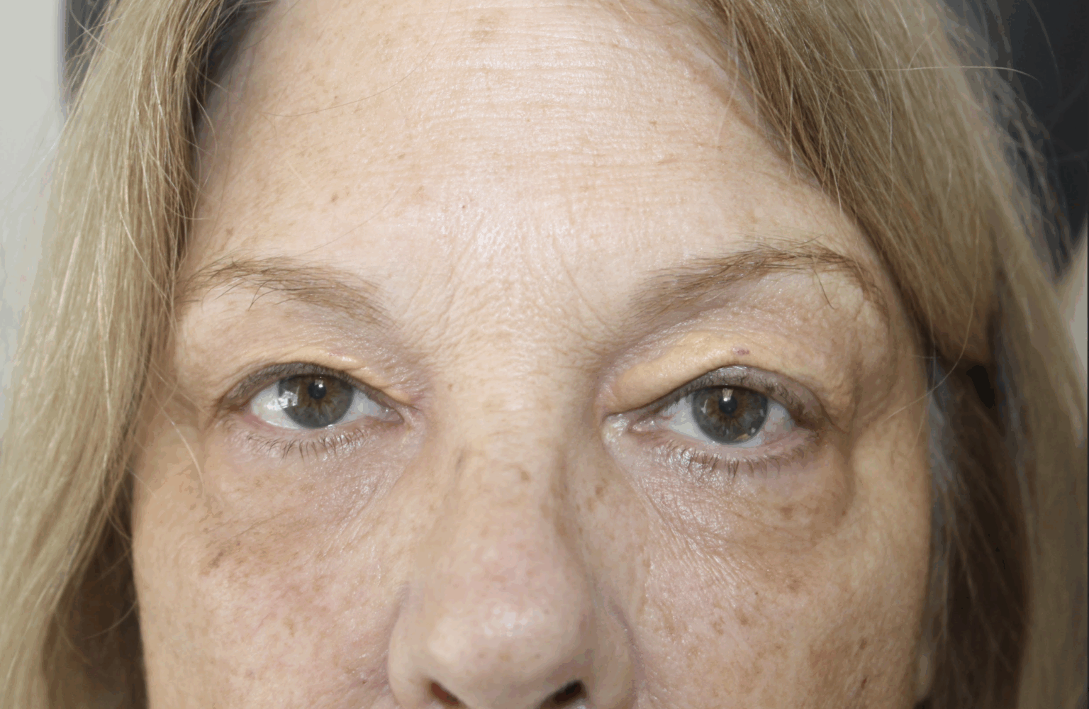 Xanthelasma Excision and Reconstruction Before