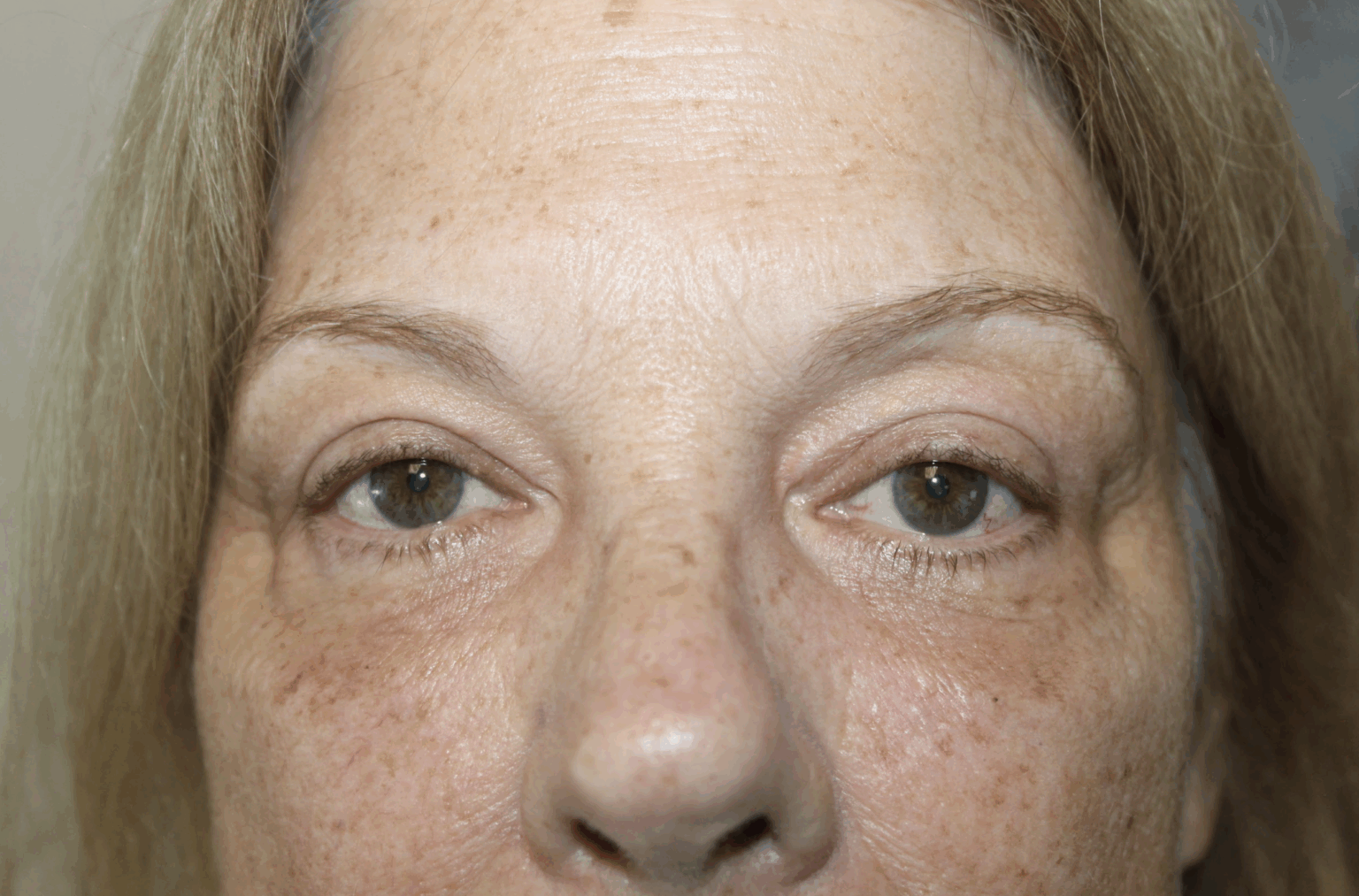 Xanthelasma Excision and Reconstruction After
