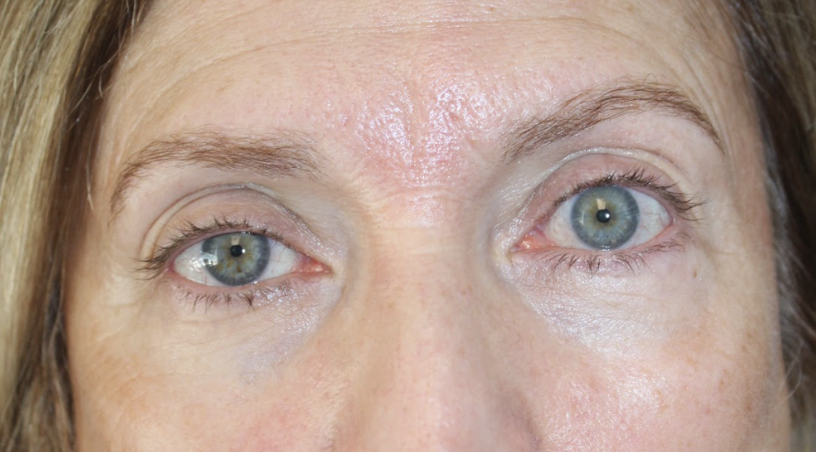 Right upper eyelid Ptosis Repair Before