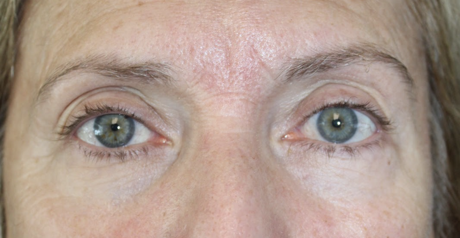Right upper eyelid Ptosis Repair After