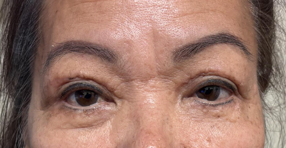 Ptosis Repair BUL & Blepharoplasty After