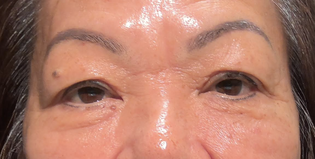 Ptosis Repair BUL & Blepharoplasty Before