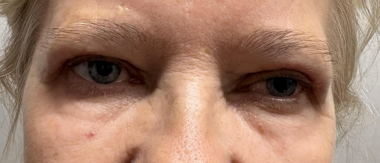 Ptosis Repaid After