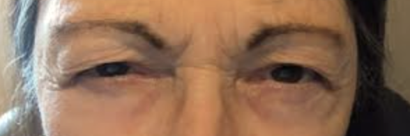 Post Ptosis Repair w/ Levator Advancement, w/ Direct Temporal Brow Lift Before