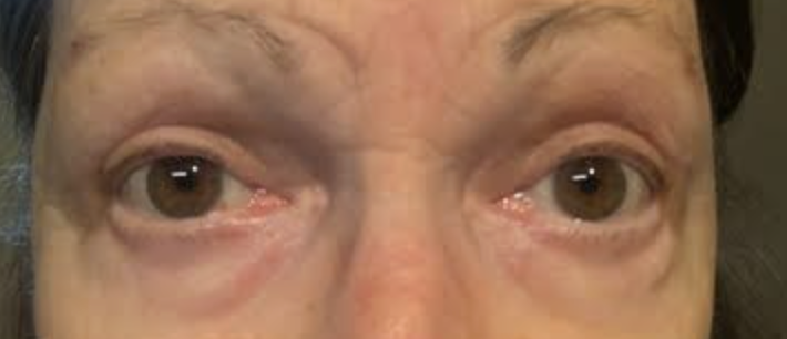 Post Ptosis Repair w/ Levator Advancement, w/ Direct Temporal Brow Lift After