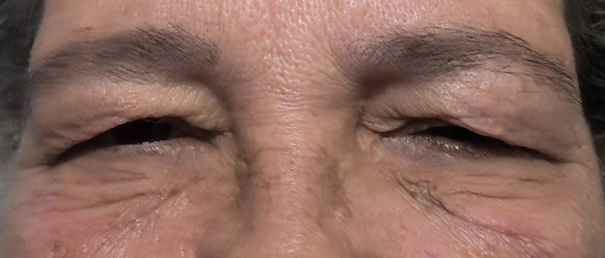 Ptosis Repair Before