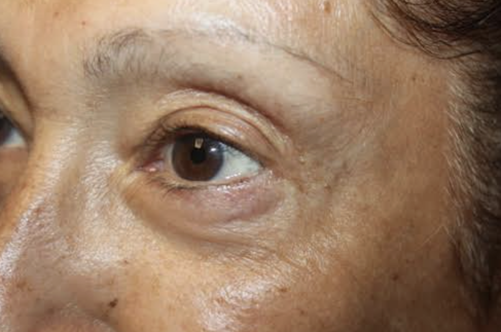 Cosmetic Upper and Lower Blepharoplasty After