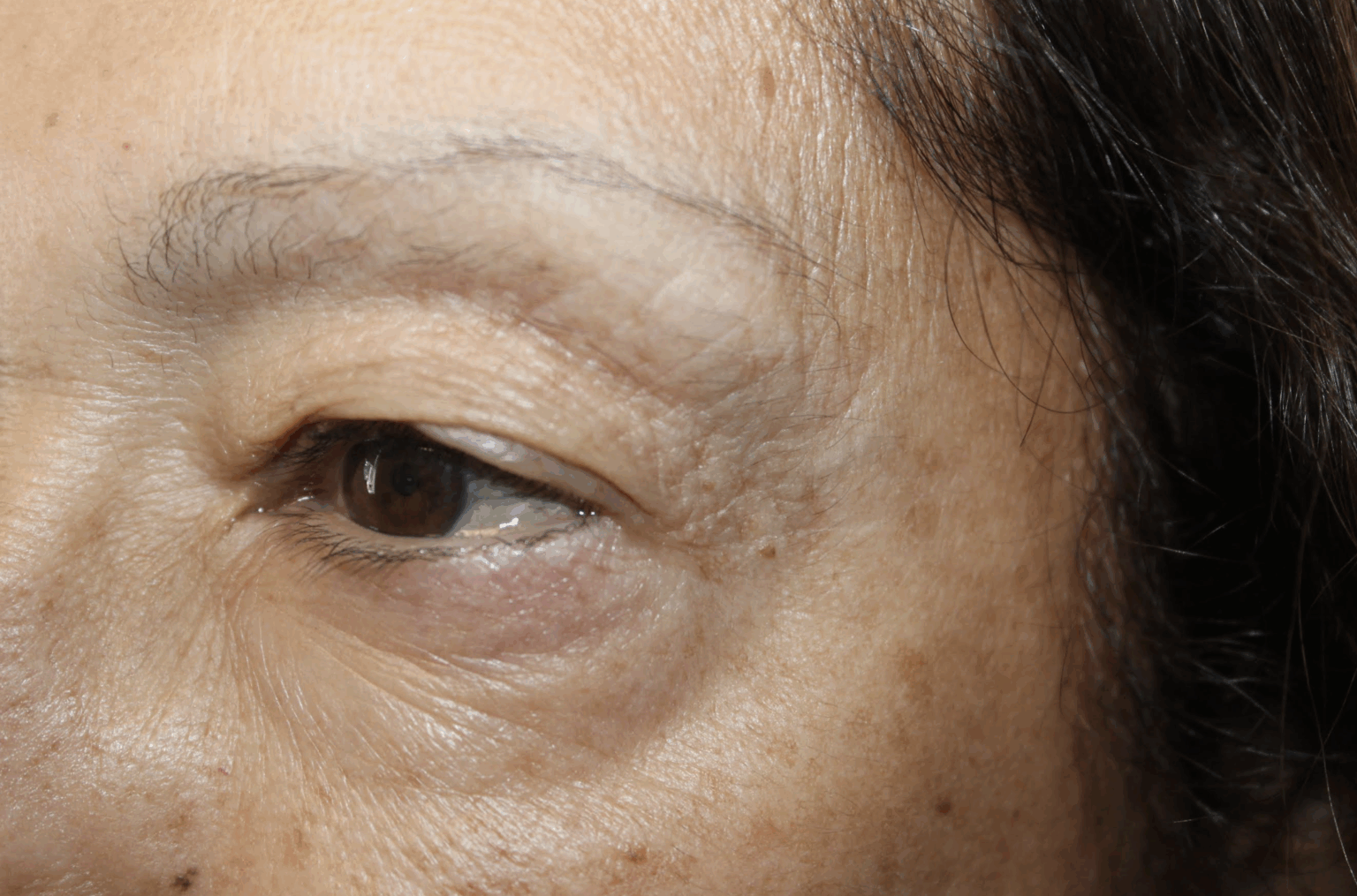 Cosmetic Upper and Lower Blepharoplasty Before