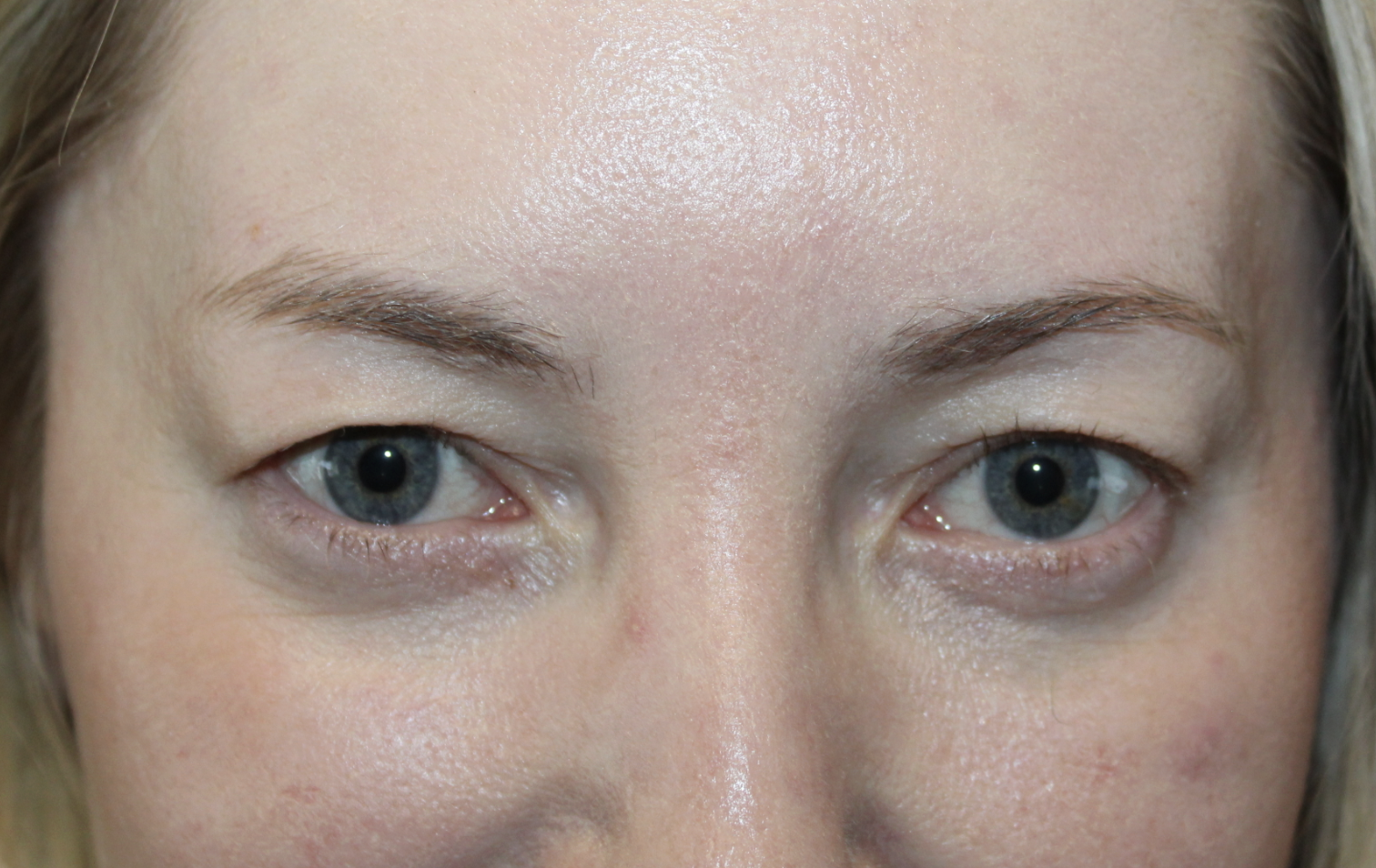 Before and immediately after upper blepharoplasty Before