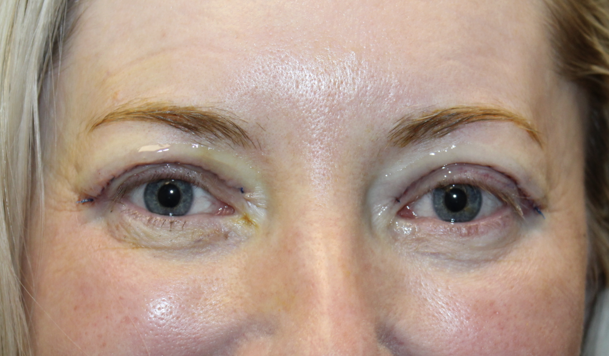 Before and immediately after upper blepharoplasty After