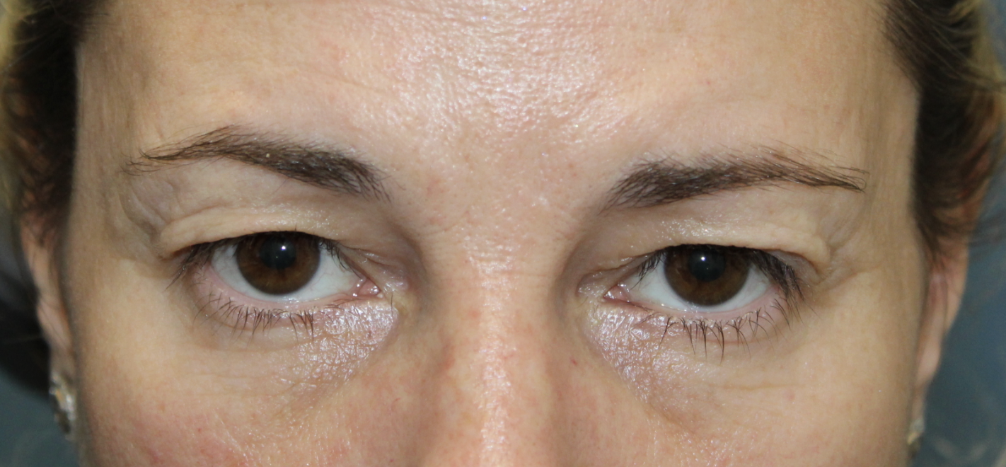 Bilateral upper blepharoplasty Before