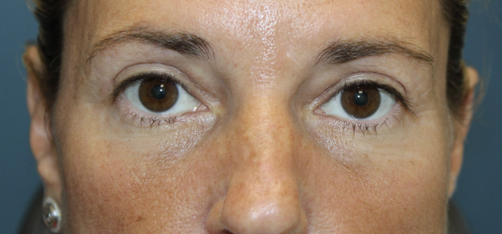 Bilateral upper blepharoplasty After