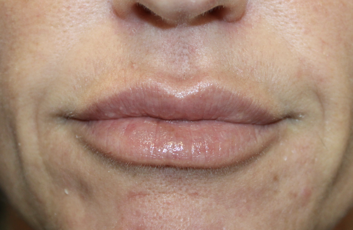Lip Filler Treatment After