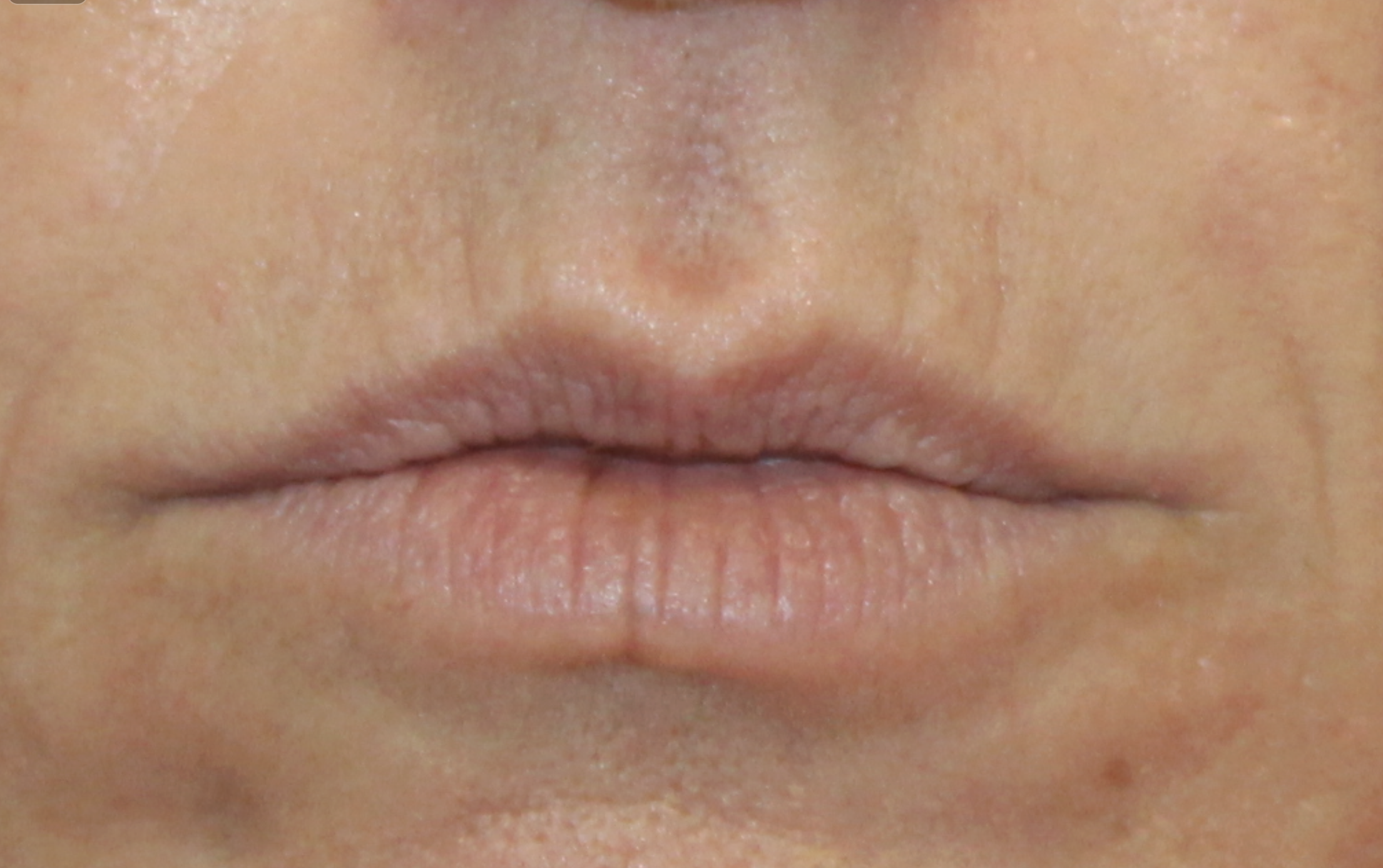 Lip Filler Treatment Before
