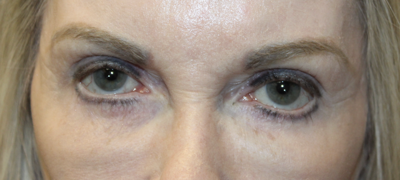 Correction of post-surgical lower eyelid retraction Before