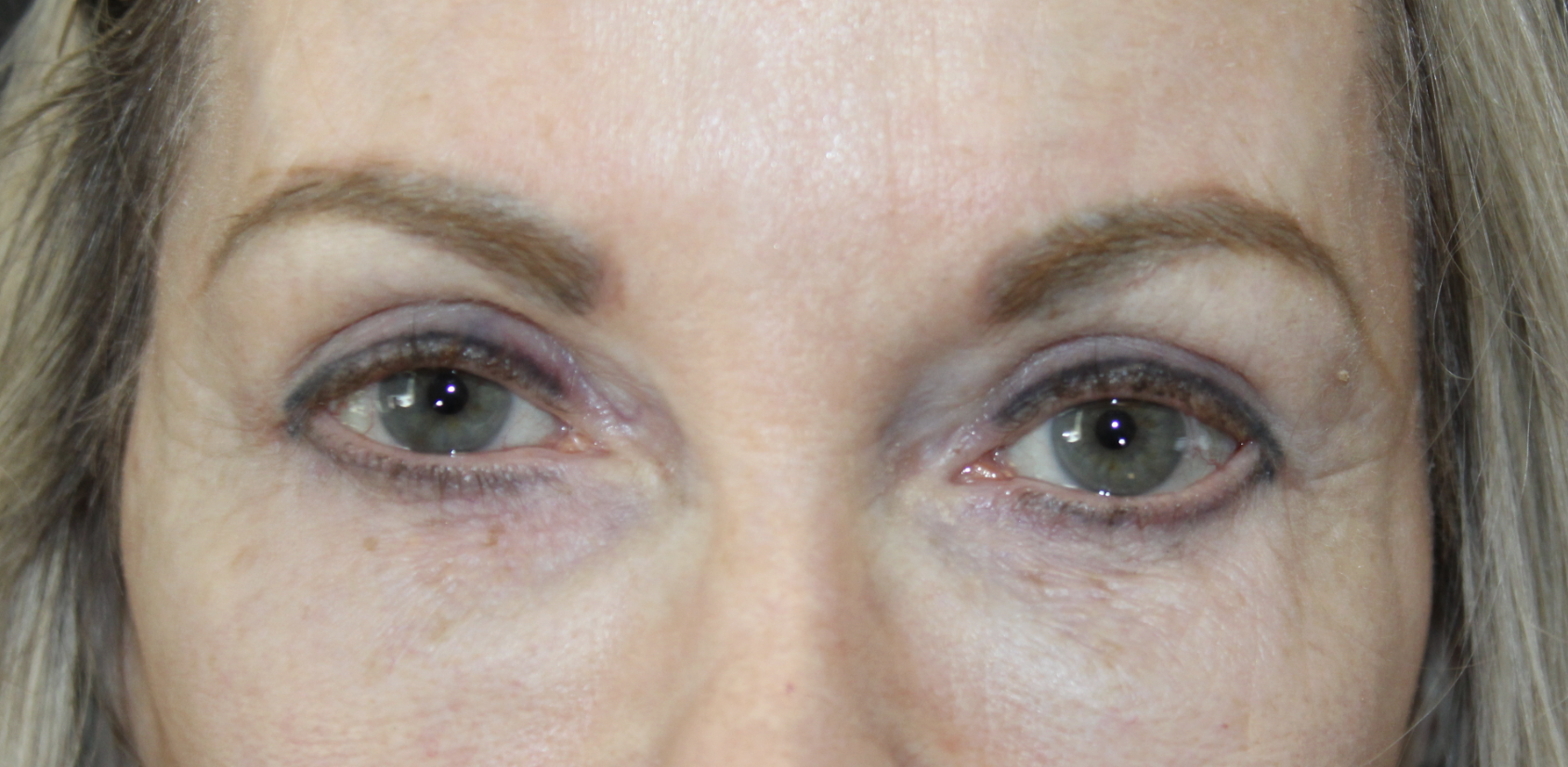 Correction of post-surgical lower eyelid retraction After