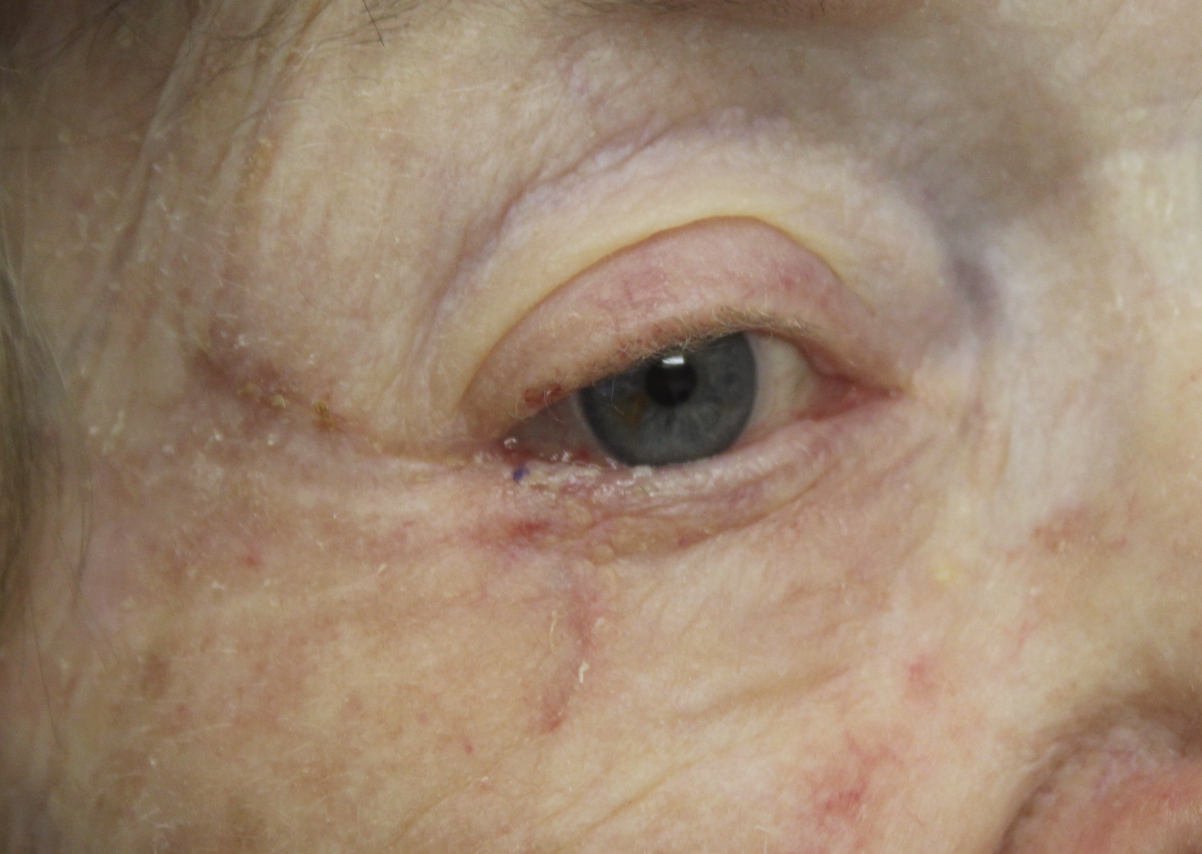 1 month following reconstruction for squamous cell carcinoma After