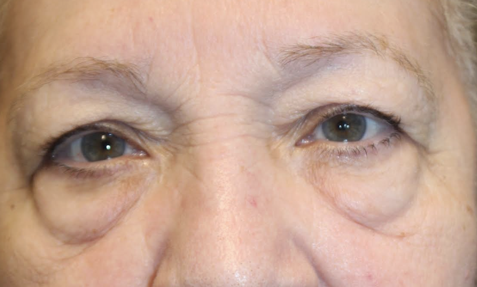 Cosmetic Lower Blepharoplasty Before