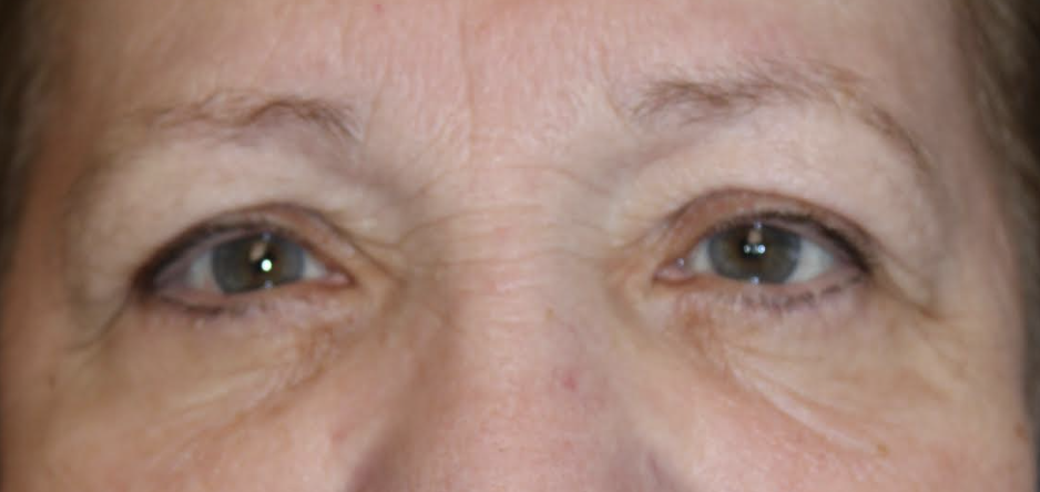 Cosmetic Lower Blepharoplasty After