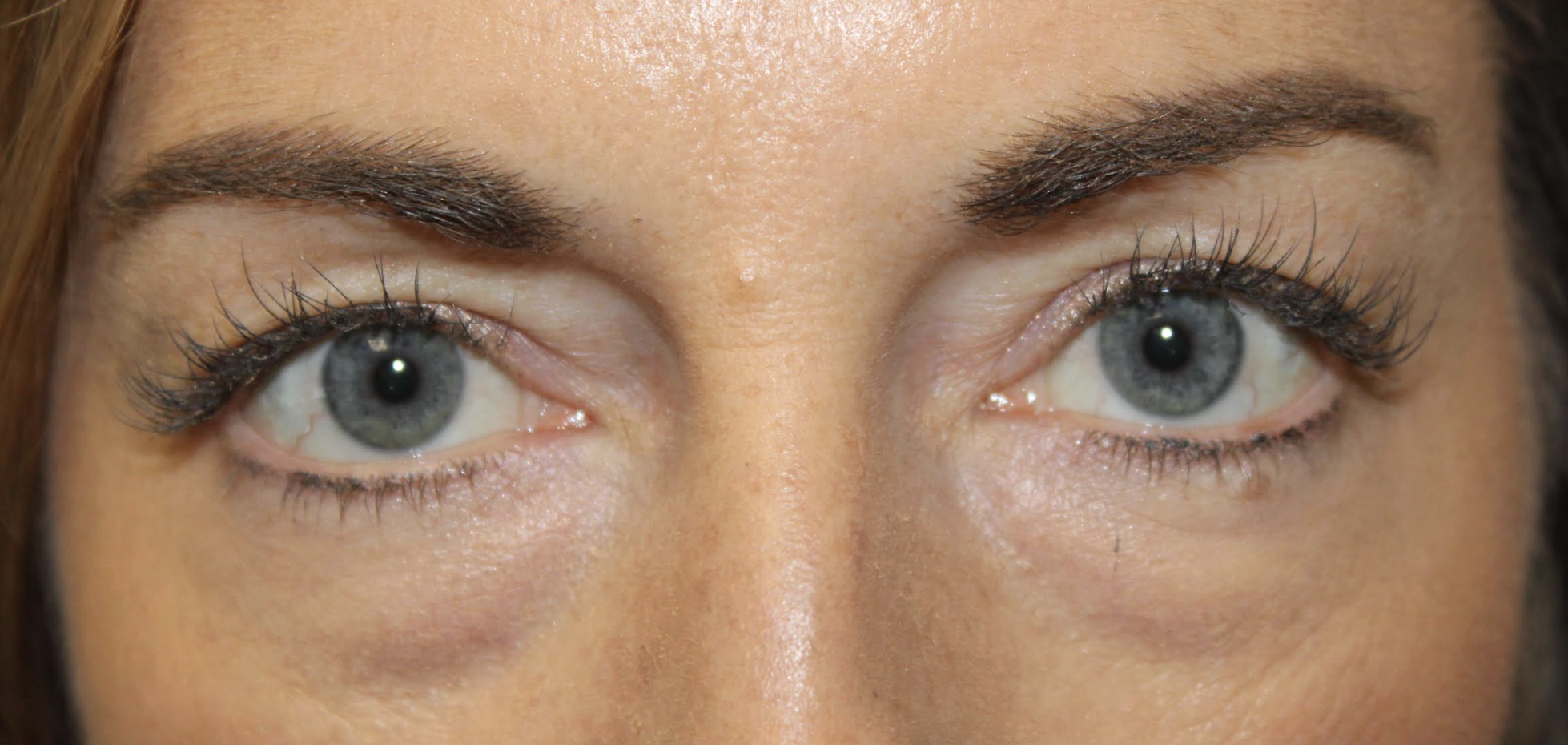 Cosmetic Upper & Lower blepharoplasty Before