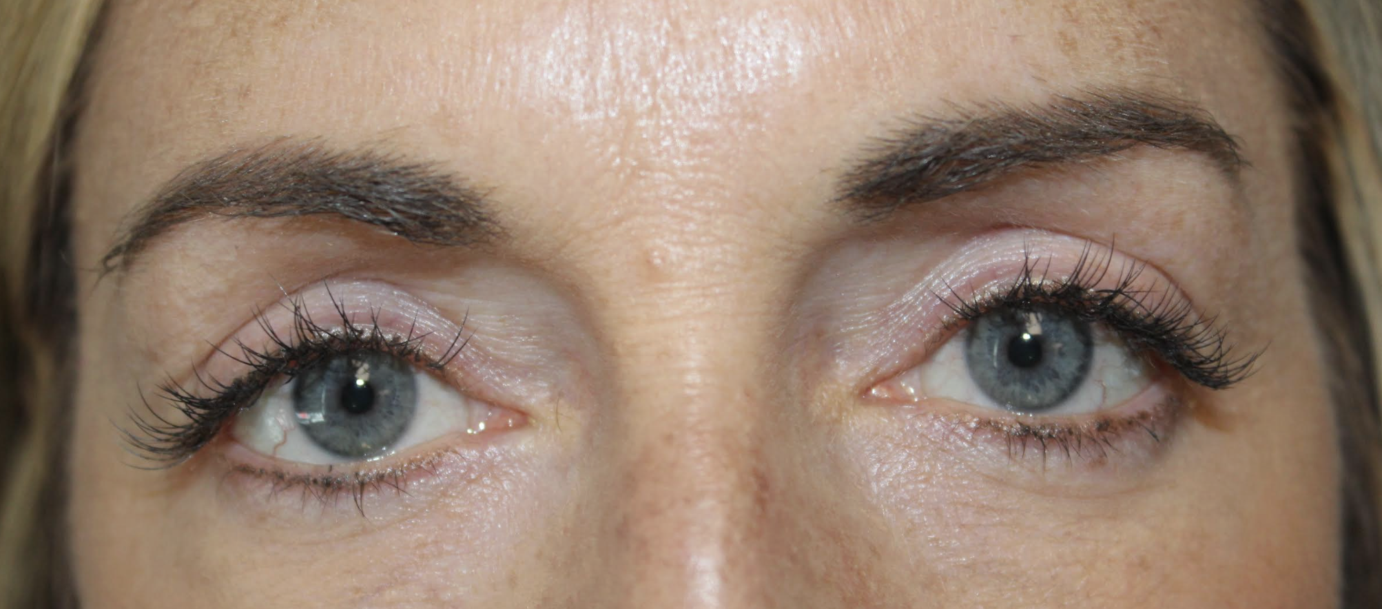 Cosmetic Upper & Lower blepharoplasty After
