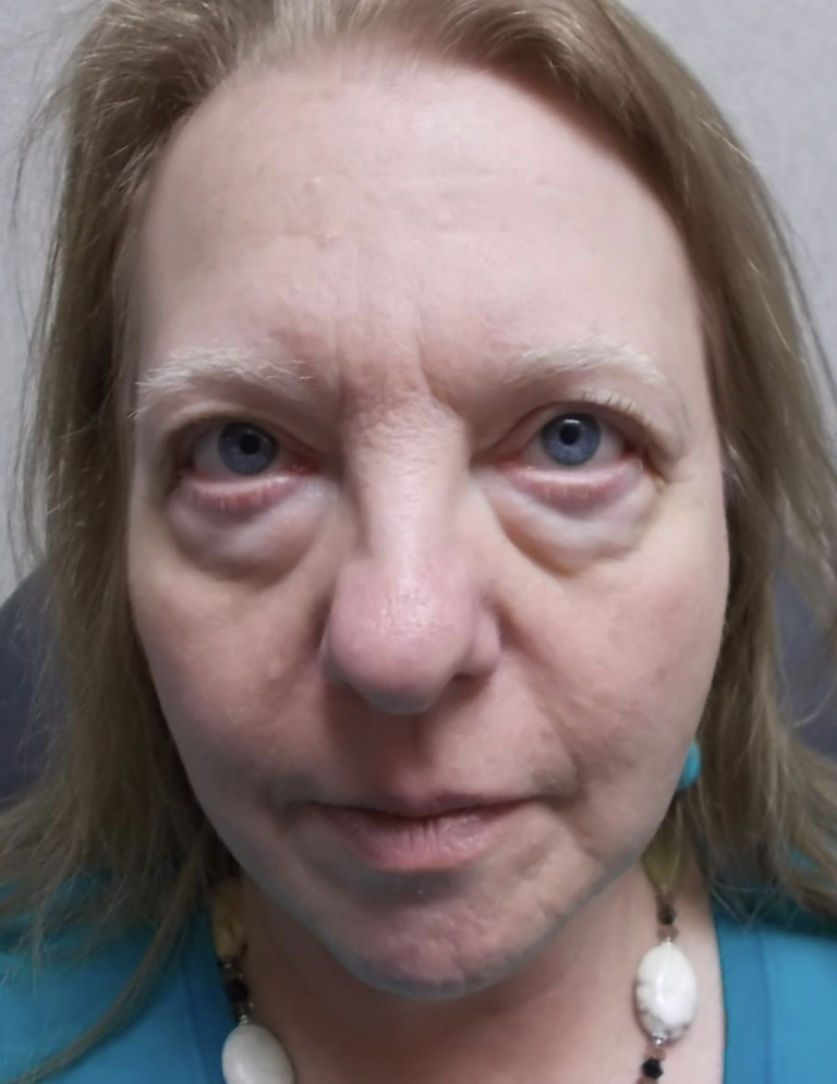 Cosmetic Upper and Lower Blepharoplasty Bilateral Canthoplasty Botox & Obagi Chemical Peels CO2 Laser Resurfacing to Full Face Before