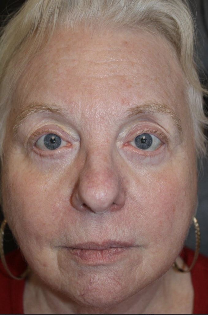 Cosmetic Upper and Lower Blepharoplasty Bilateral Canthoplasty Botox & Obagi Chemical Peels CO2 Laser Resurfacing to Full Face After