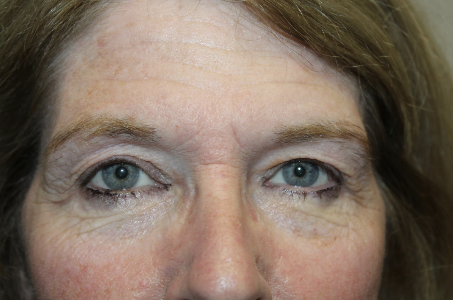 Cosmetic Upper & Lower Blepharoplasty, Botox to Forehead, CO2 Laser Resurfacing to Full Face Before