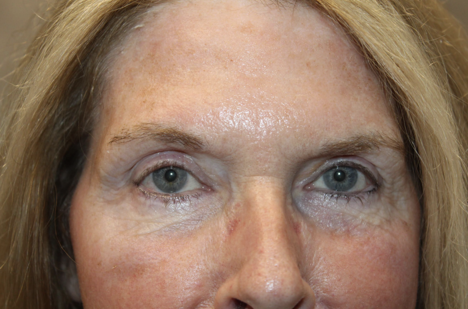 Cosmetic Upper & Lower Blepharoplasty, Botox to Forehead, CO2 Laser Resurfacing to Full Face After