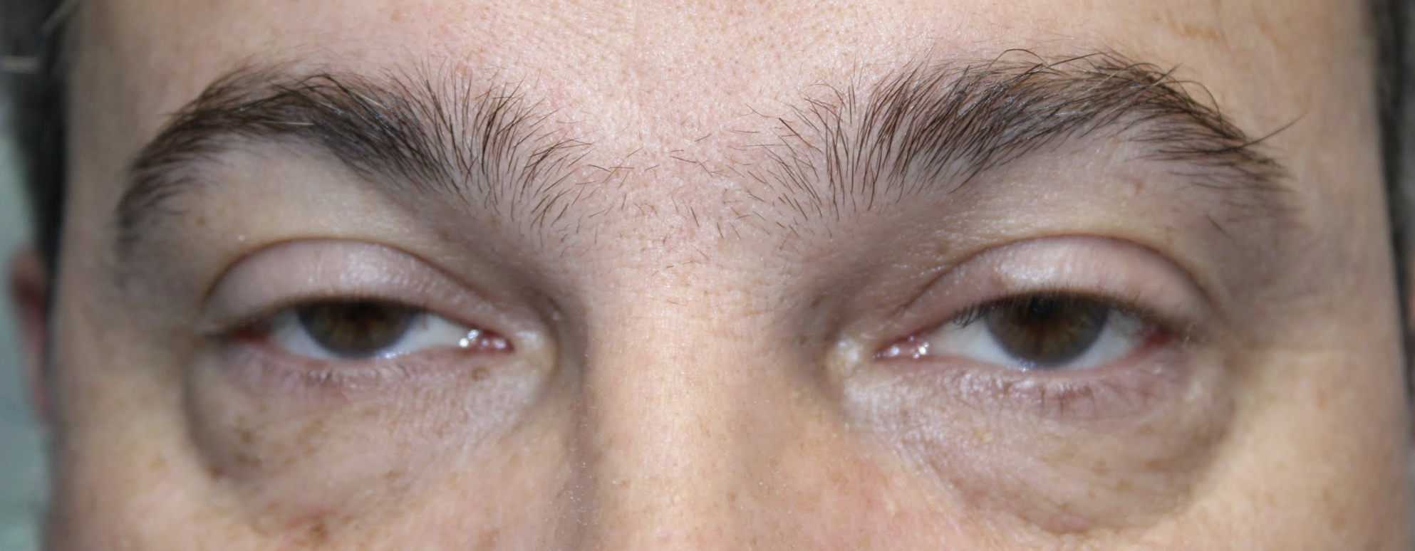 Bilateral Ptosis Repair Before