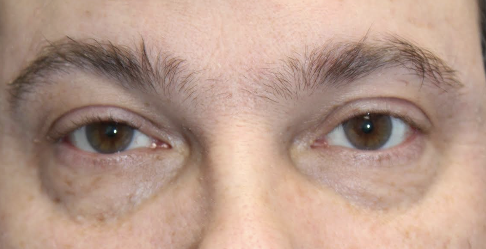Bilateral Ptosis Repair After