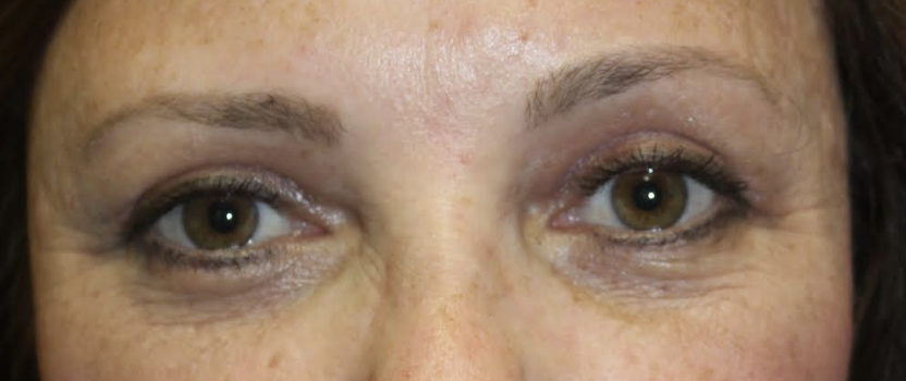 Cosmetic Upper/Lower Blepharoplasty with Botox to Glabella, Crow's Feet, and Forehead After