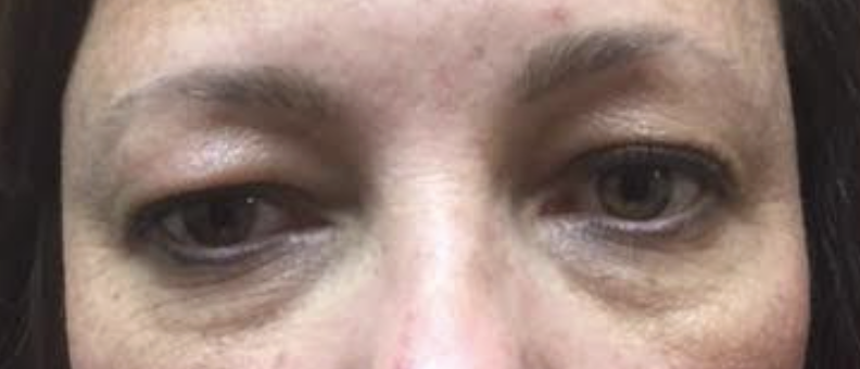 Cosmetic Upper/Lower Blepharoplasty with Botox to Glabella, Crow's Feet, and Forehead Before
