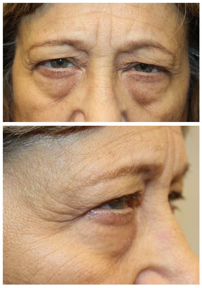 Direct brow ptosis repair, external ptosis repair, lower eyelid blepharoplasty with canthopexy Before