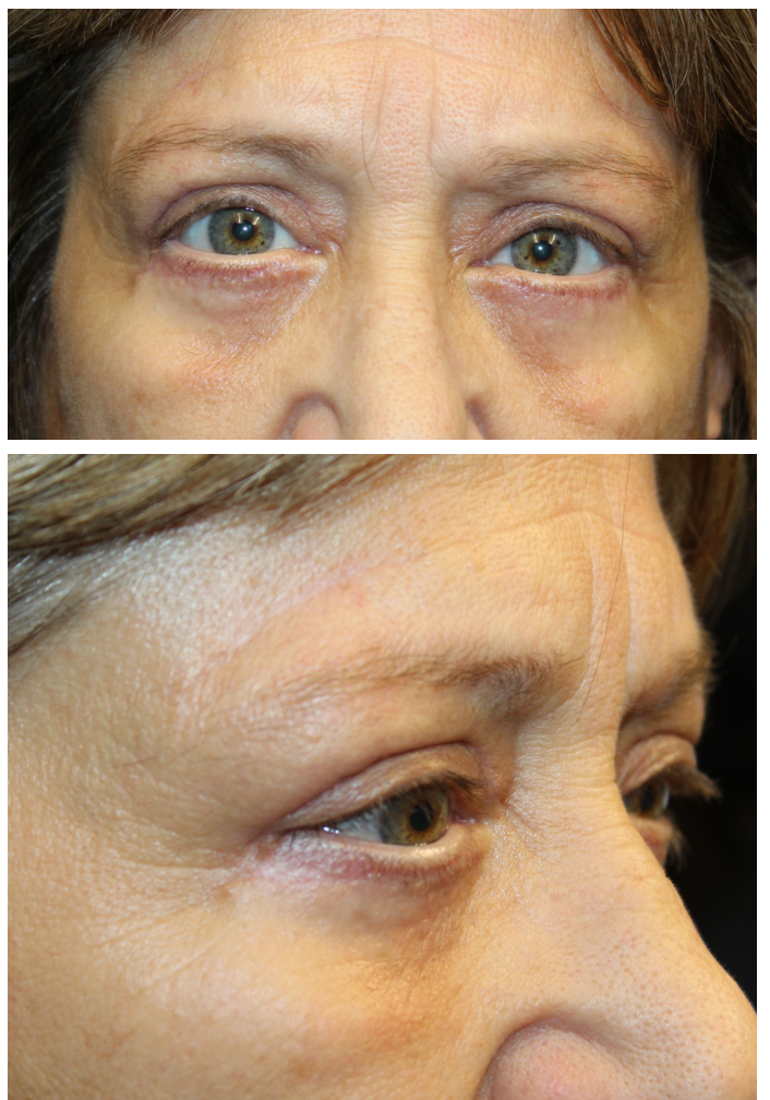 Direct brow ptosis repair, external ptosis repair, lower eyelid blepharoplasty with canthopexy After