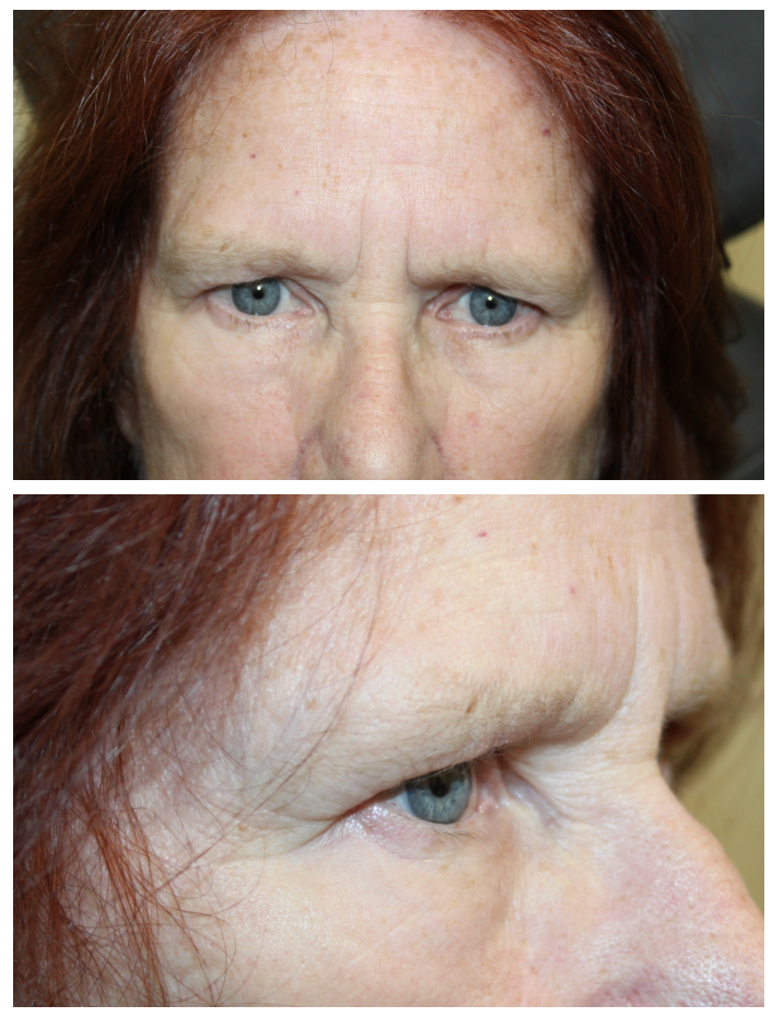 2 months following a direct brow ptosis repair Before