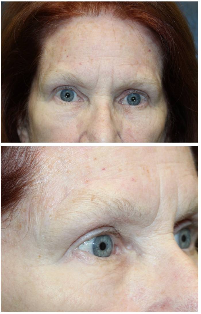 2 months following a direct brow ptosis repair After