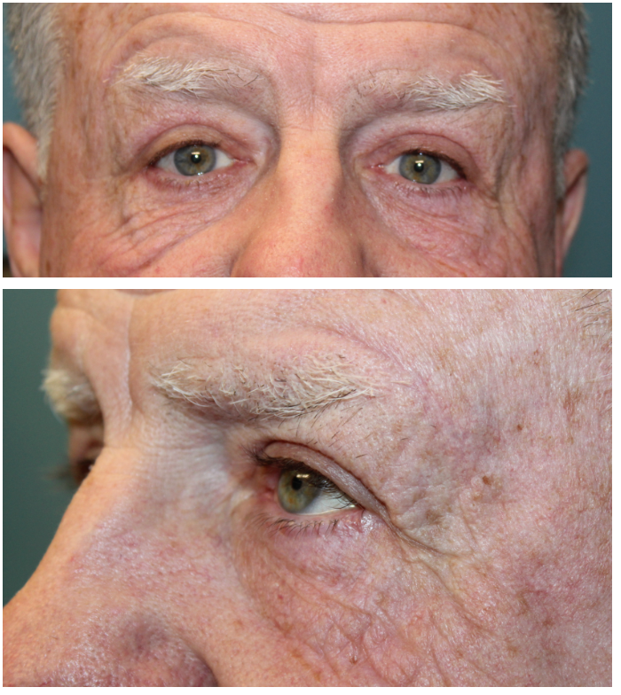 2 months following direct brow ptosis repair, ectropion repair, and upper blepharoplasty After