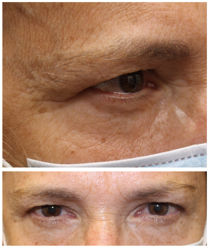 Upper Blepharoplasty and Direct Brow Ptosis Repair Before