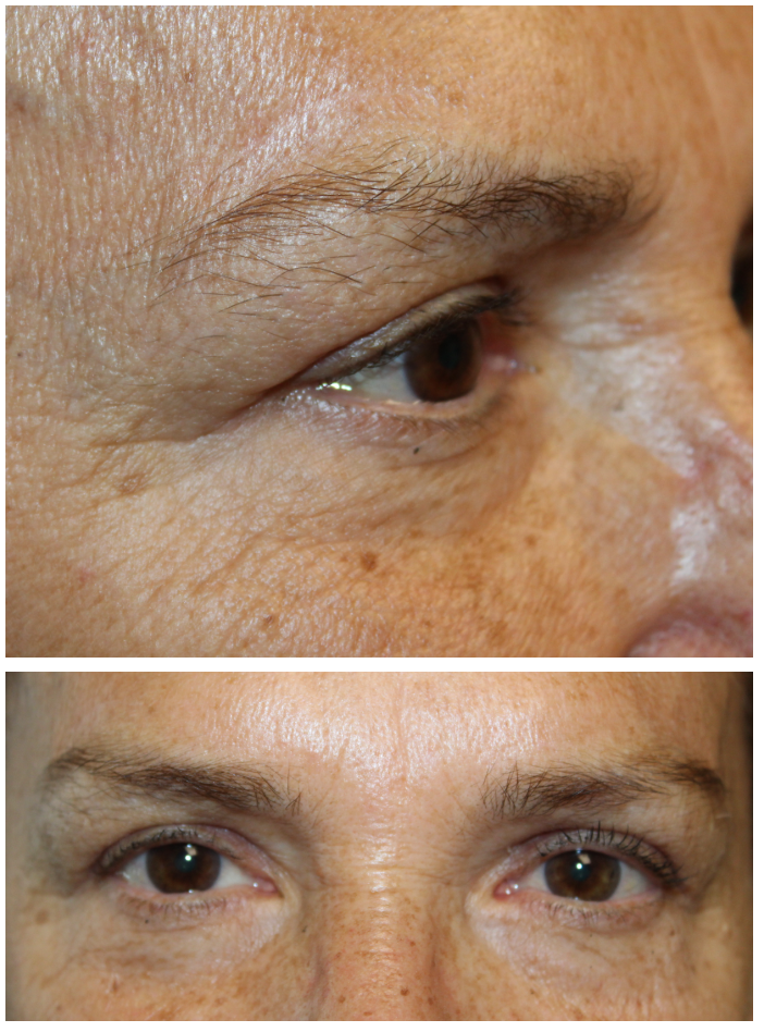 Upper Blepharoplasty and Direct Brow Ptosis Repair After