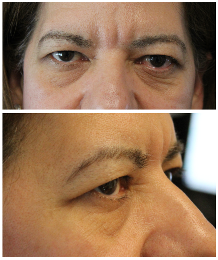 1 week following upper and lower blepharoplasty with skin pinch, canthopexy, and fat transposition Before