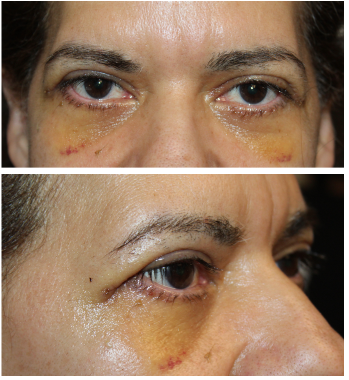 1 week following upper and lower blepharoplasty with skin pinch, canthopexy, and fat transposition After