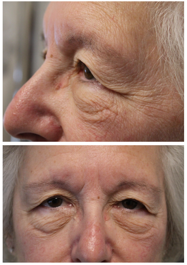 Upper and Lower blepharoplasty with TCA Peel Before