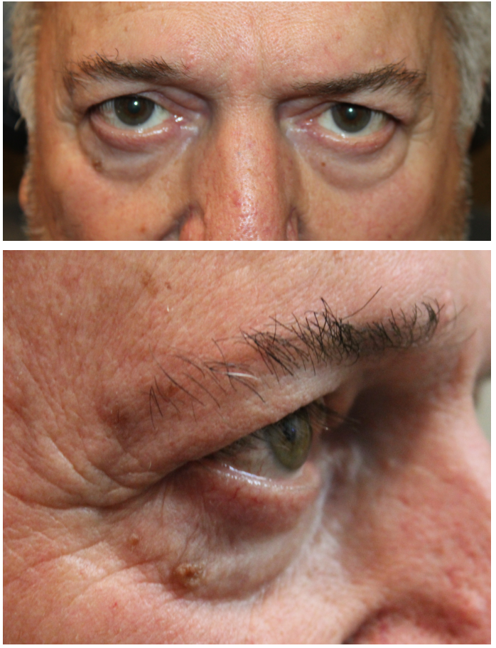 Upper and Lower Eyelid Blepharoplasty with Lower Eyelid Fat Transposition Before