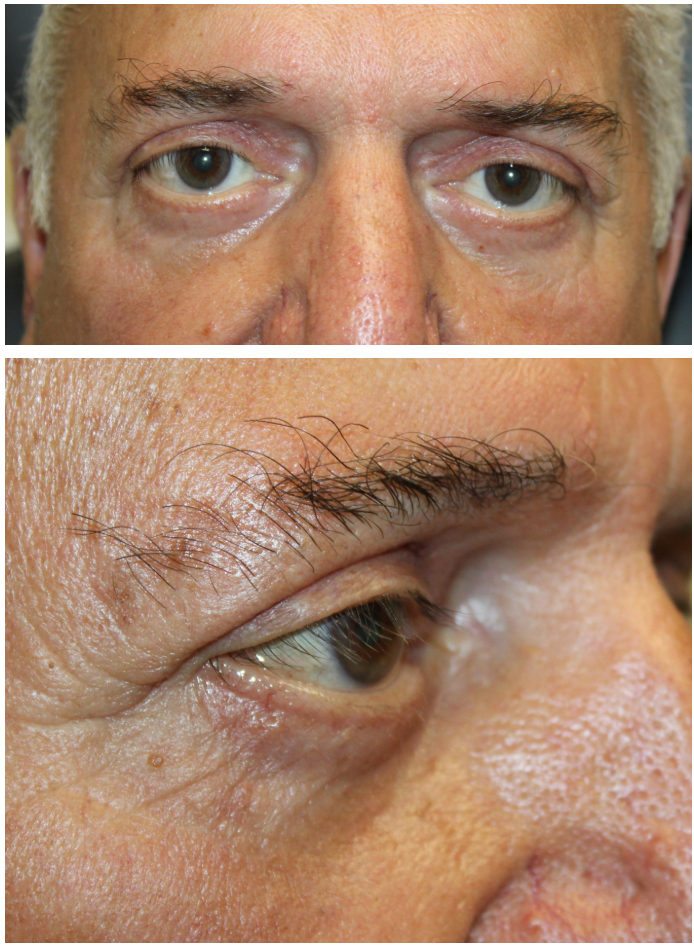 Upper and Lower Eyelid Blepharoplasty with Lower Eyelid Fat Transposition After