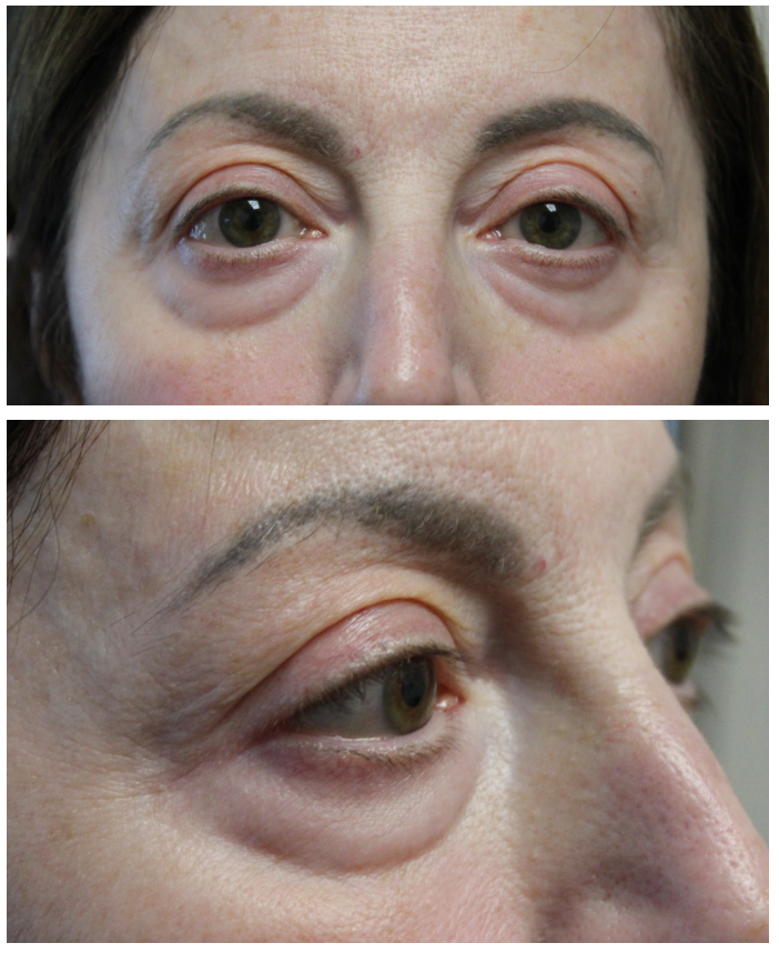 Upper and Lower Eyelid Blepharoplasty with TCA Peel and Canthopexy Before