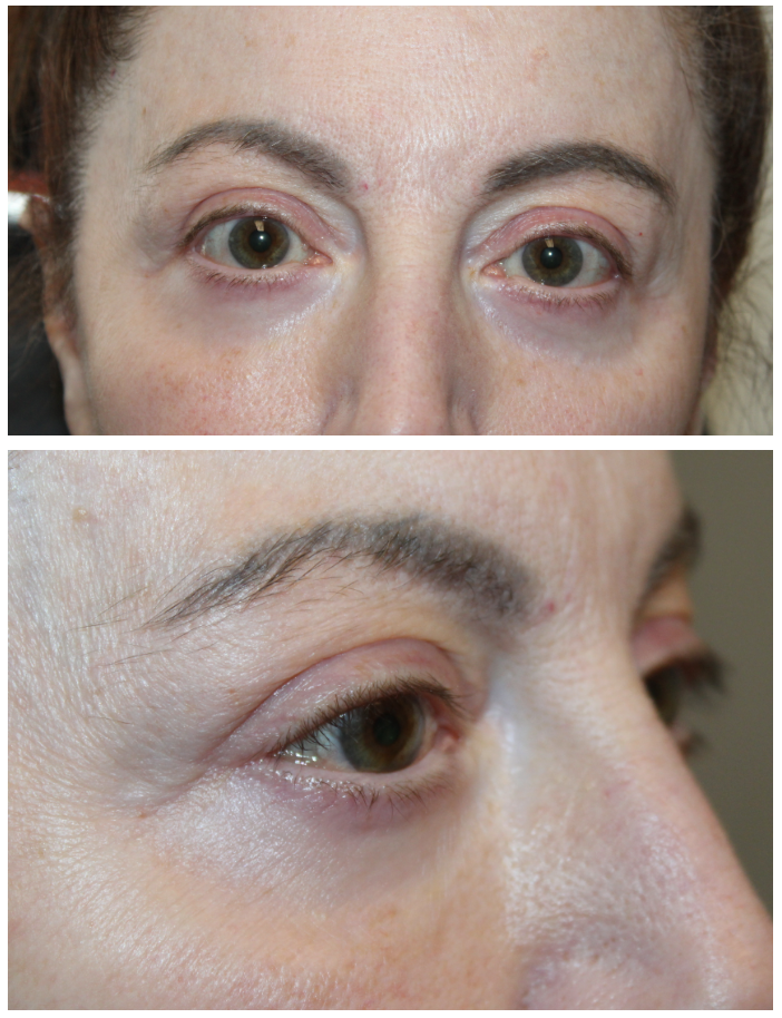 Upper and Lower Eyelid Blepharoplasty with TCA Peel and Canthopexy After