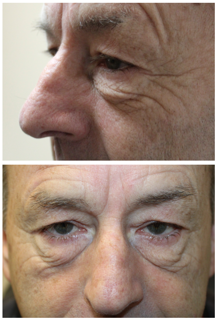 Upper and Lower Eyelid Blepharoplasty and Upper Eyelid Ptosis Repair. Before