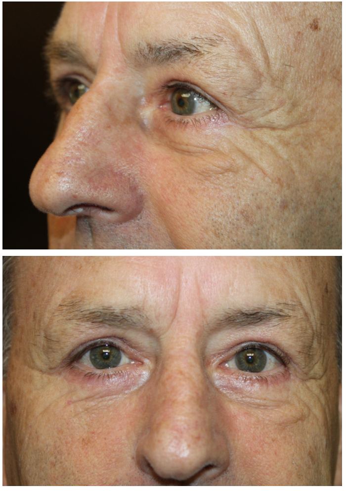 Upper and Lower Eyelid Blepharoplasty and Upper Eyelid Ptosis Repair. After