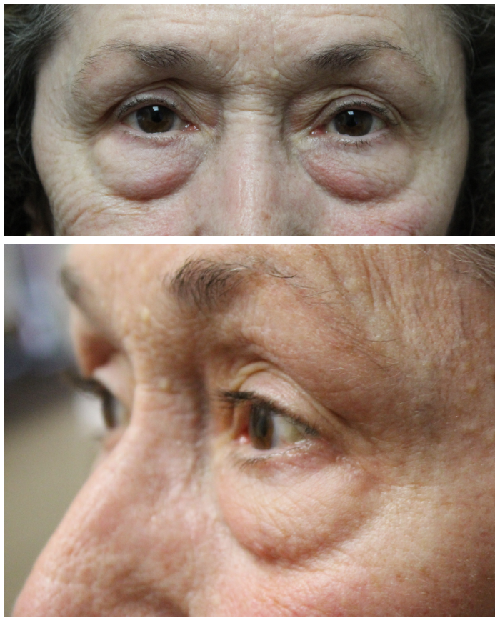 Upper and Lower Blepharoplasty with TCA Peel Before